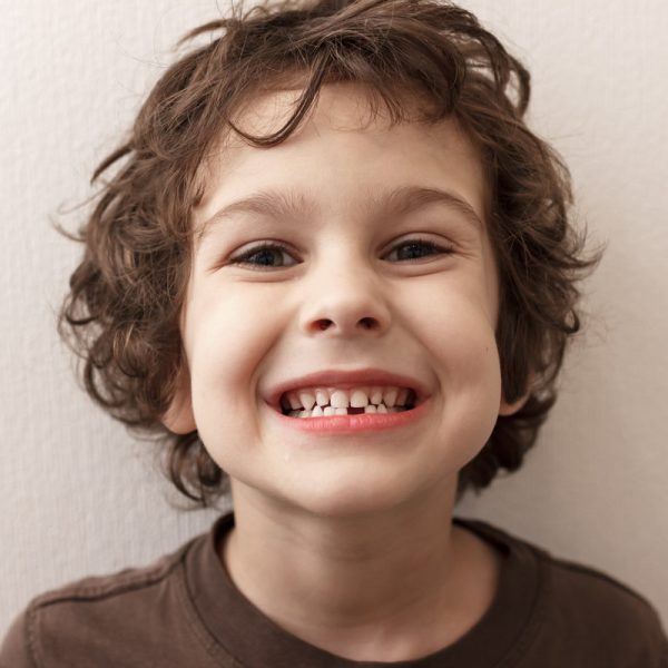 Charming curly boy smiles. The boy lost the first milk tooth